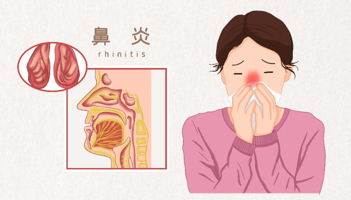 摄图网_401809158_鼻炎医疗插图(非企业商用).jpg 摄图网_401809158_鼻炎医疗插图(非企业商用).jpg
