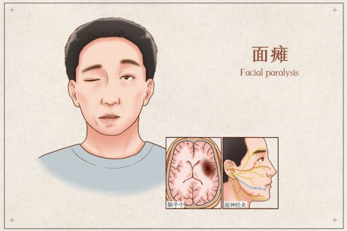 摄图网_401863680_面瘫医疗插画(非企业商用).jpg 摄图网_401863680_面瘫医疗插画(非企业商用).jpg